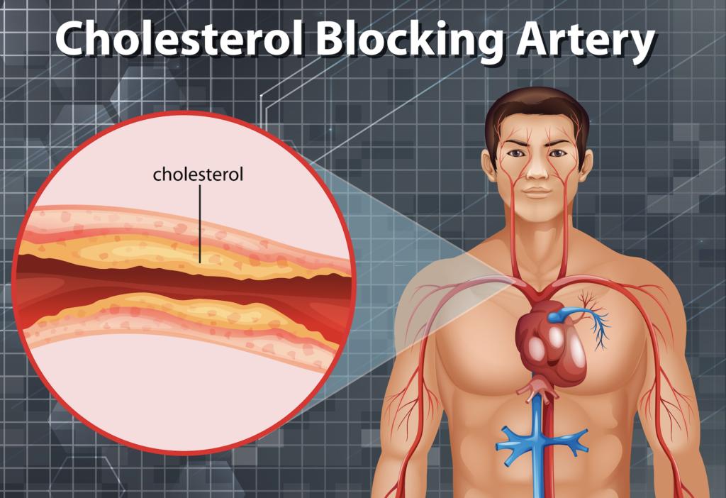 7 conseils alimentaires pour rééquilibrer le cholestérol
